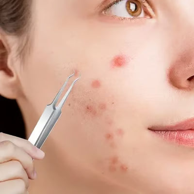 ملقط ازالة الرؤوس السوداء (03قطع)